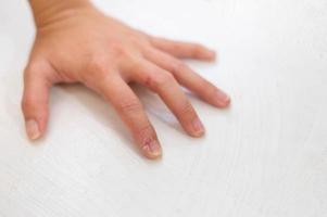 Close up of fingers female hand with dry, cracked skin on cuticles, skin is torn and flaking off should be treat with the moisturizer for repair. photo