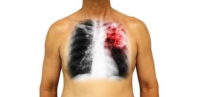 Pulmonary tuberculosis . Human chest with x-ray show patchy infiltrate left upper lung due to infection . Isolated background photo