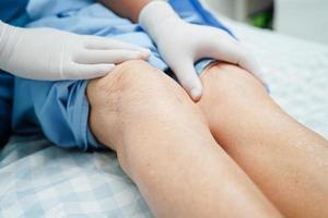 Doctor checking Asian elderly woman patient with scar knee replacement surgery in hospital. photo