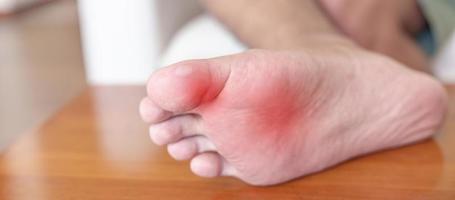 man having bunion toes or blister due to wearing narrow shoes and waking or running longtime, barefoot pain due to Plantar fasciitis. Health and medical concept photo