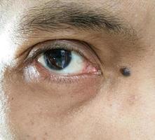 brown eyes of an asian man with a mole next to it photo