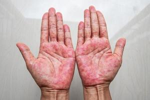 Hands with rash. Red sports on the hand, palm and fingers. photo