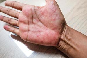 Red rash on the hands of the palms  ,and other infectious viral diseases in children and adults photo