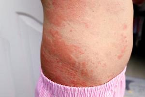 Strong allergic rashes on the body Impaired immunity and reaction to allergenic products. Dermatological rash on the skin and body The problem of health . Immune System Disease, Allergy photo