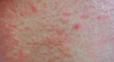 Erupción urticaria por alergia a medicamentos. foto