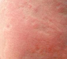 Strong allergic rashes on the thigh. Impaired immunity and reaction to allergenic products. Dermatological rash on the skin and body The problem of health and cosmetology. photo