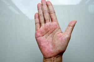 Atopic dermatitis also known as atopic eczema is a type of inflammation of the skin at Hands photo