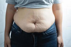 Obese woman needs weight control, she has excess fat. photo