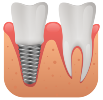 Dental implant structure, human teeth and dental implant png