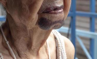 Close up chin senior woman has bruises photo