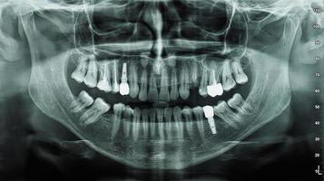 orthopantomograph panoramic image radiograph of teeth photo