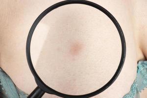 mancha roja de erupción en el pecho femenino, examen médico en el primer plano del cáncer de mama foto