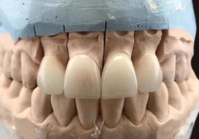 Dental gypsum model in dentist laboratory office - close-up. Gypsum Dentures with porcelain teeth isolated on black background. Artificial jaw with a ceramic crown on implants photo