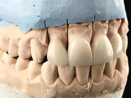 Dental zirconia crowns in the plaster model. White front teeth veneers on diagnostic model on dark background. Closeup of dental prosthesis porcelain teeth in a mold. Dental clinic. photo