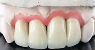 Ceramic dental bridge on plaster model. Dental prosthesis manufacturing workshop. Full wax denture. Dental implant. Restoration of teeth. Dental laboratory, clinic. Implants of jaw of person photo