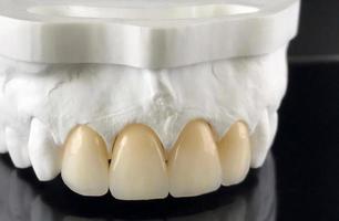 Zirconia crowns with all porcelain baked. Close-up view of dental layout of upper veneers of teeth prosthesis, isolated on black background. Dental crowns for the upper jaw on model photo