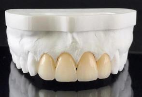 coronas de zirconio con porcelana full en el modelo de yeso para tratamiento dental. restauración de dientes en el maxilar superior. producción de carillas dentales en un laboratorio dental. carillas foto