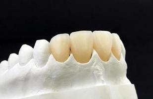 Dental zirconia crowns in the plaster model. White dental veneers on black background. Zirconia bridge and crown with porcelain in the model for dentist. Press ceramic veneers A2 color photo