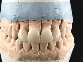 primer plano de prótesis dentales dientes de porcelana en un molde. modelo de yeso de mandíbula dental y equipo dental sobre fondo negro, concepto de imagen médica de salud dental, higiene dental foto