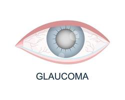 ojo con vista de primer plano de glaucoma. globo ocular borroso, enrojecido y lloroso. órgano humano de la visión con problemas visuales de envejecimiento vector