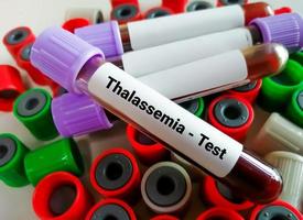 Blood sample for Thalasemmia testing. photo