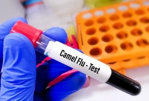 gripe de camello o síndrome respiratorio de oriente medio mers análisis de sangre