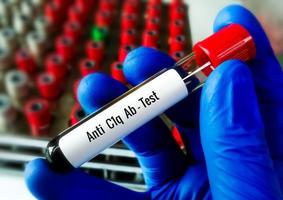 Blood sample for Anti-C1q antibody test. SLE. photo