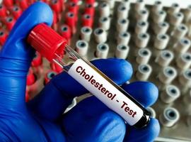 muestra de sangre para prueba de colesterol, perfil de lípidos. infarto de miocardio. foto