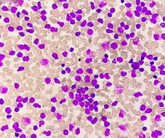Blood smear under microscopy showing chronic lymphoblastic leukemia or CLL photo