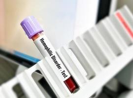 Blood sample for inherited bleeding disorder test, hemophilia. photo