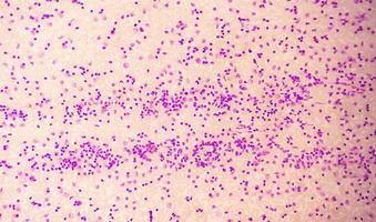 Blood smear under microscopy showing chronic lymphoblastic leukemia or CLL photo