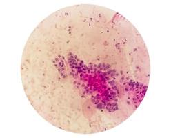 Microscopic view of Trichomonas vaginalis in pap smear with few acute inflammatory cells. photo