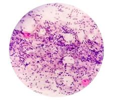 Paps smear. Microscopic examination of pap smear showing inflammatory smear with early atrophic changes. cervical cancer diagnosis. photo