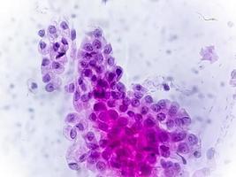 vista microscópica de trichomonas vaginalis en una prueba de Papanicolaou con pocas células inflamatorias agudas. foto