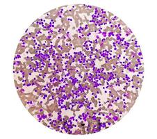 frotis de sangre bajo microscopía que muestra leucemia linfoblástica crónica o cll foto