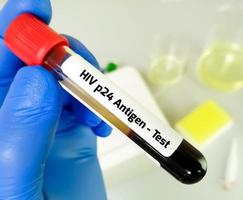 HIV p24 antigen test for the early diagnosis of HIV infection. photo