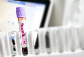 Blood sample for inherited bleeding disorder test, hemophilia. photo