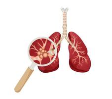 Lung cancer diagram. Detailed illustration vector