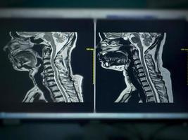 MRI Cervical-spine Shows C4-C5 Moderate spinal cord compression photo