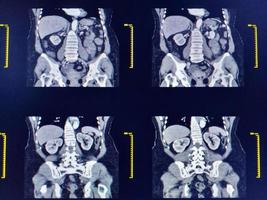 tomografía computarizada de abdomen completo con vista coronal de medio de contraste. concepto de tecnología médica. foto