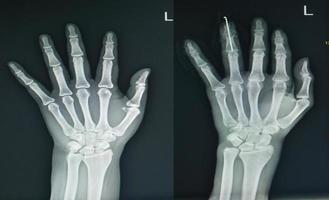 x-ray left hand two views finding normal and fracture finger. photo