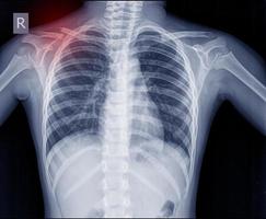 Chest x-ray fracture right clavicle. photo