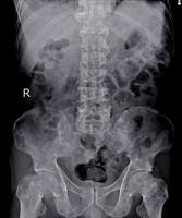 Impresión de la columna lumbar de rayos x metástasis óseas múltiples. foto