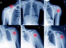 Collection Film x ray shoulder radiograph show shoulder dislocation and bone broken from accident Highlight on arrow point. Medical imaging concept. photo