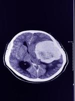 CT Brain  diameter hyperdensity mass with lobulated surface at extra-axial lateral to Lt frontal and temporal lobe photo