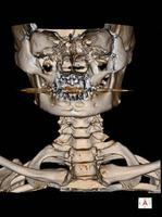 CT Scan cervical spine 3 D render.Image contains excessive noise, film grain, compression artifacts. photo