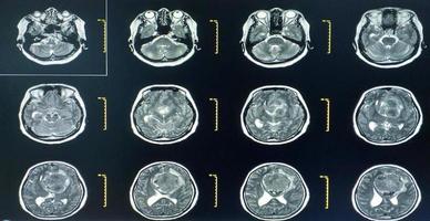 resonancia magnética cerebral hallazgo de meningioma foto