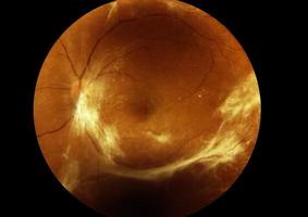 Retinal image in diabetic patients There are many white fibers . photo