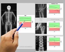 Special examination medical image bone density A female 65 year old Whole body and wrist,hip,spine,Image too blurry when views full solution,Medical and technology concept. photo