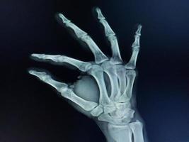 película de rayos x mano vista ap mostrar la mano del ser humano. foto